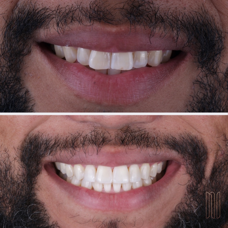 Antes e depois — caso clínico 11