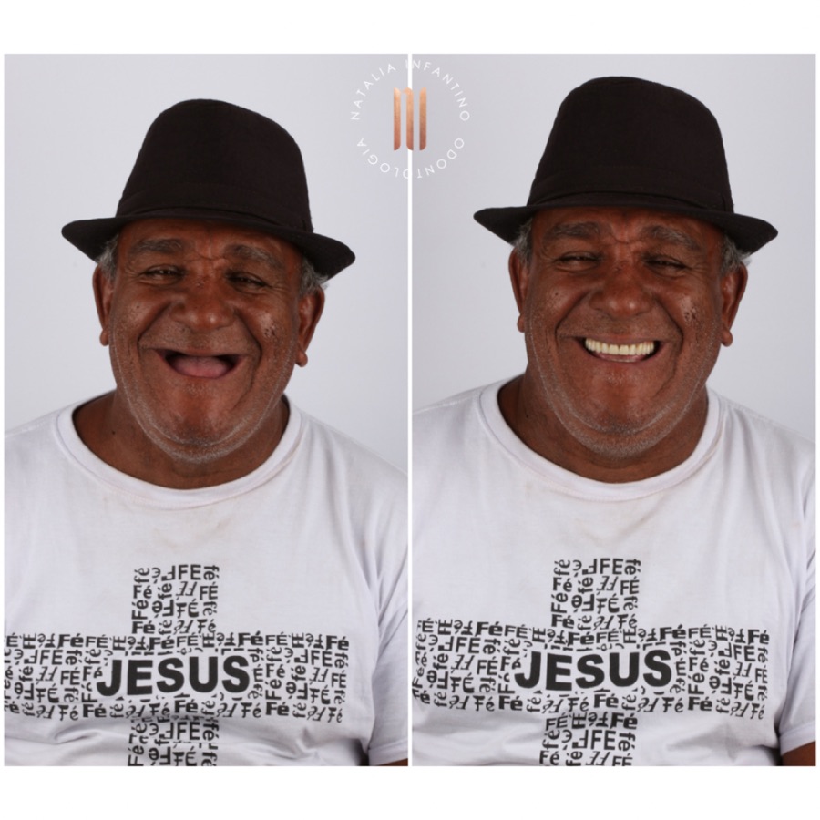Antes e depois — caso clínico 14