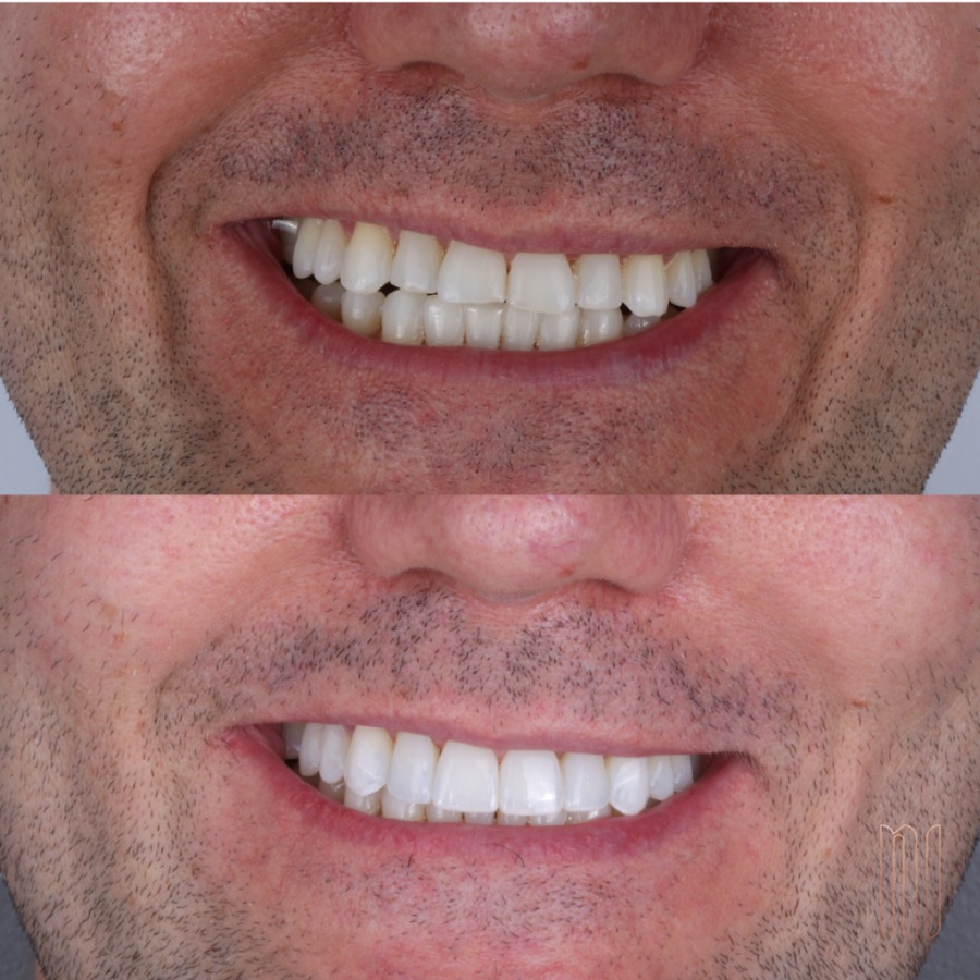 Antes e depois — caso clínico 30