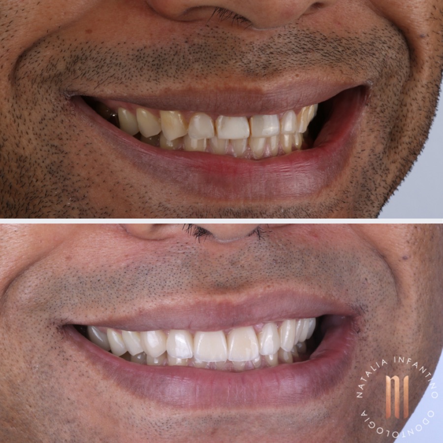 Antes e depois — caso clínico 32