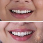 Caso antes e depois — transformação de sorriso com a Dra. Natália Infantino
