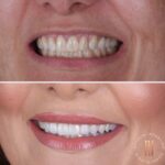 Caso antes e depois — transformação de sorriso com a Dra. Natália Infantino