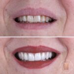 Caso antes e depois — transformação de sorriso com a Dra. Natália Infantino