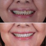 Caso antes e depois — transformação de sorriso com a Dra. Natália Infantino