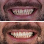 Caso antes e depois — transformação de sorriso com a Dra. Natália Infantino